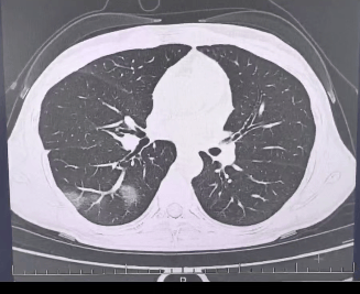 查出流感没在意<strong></p>
<p>如何进入币圈</strong>，女子硬扛三天后肺都“白”了……