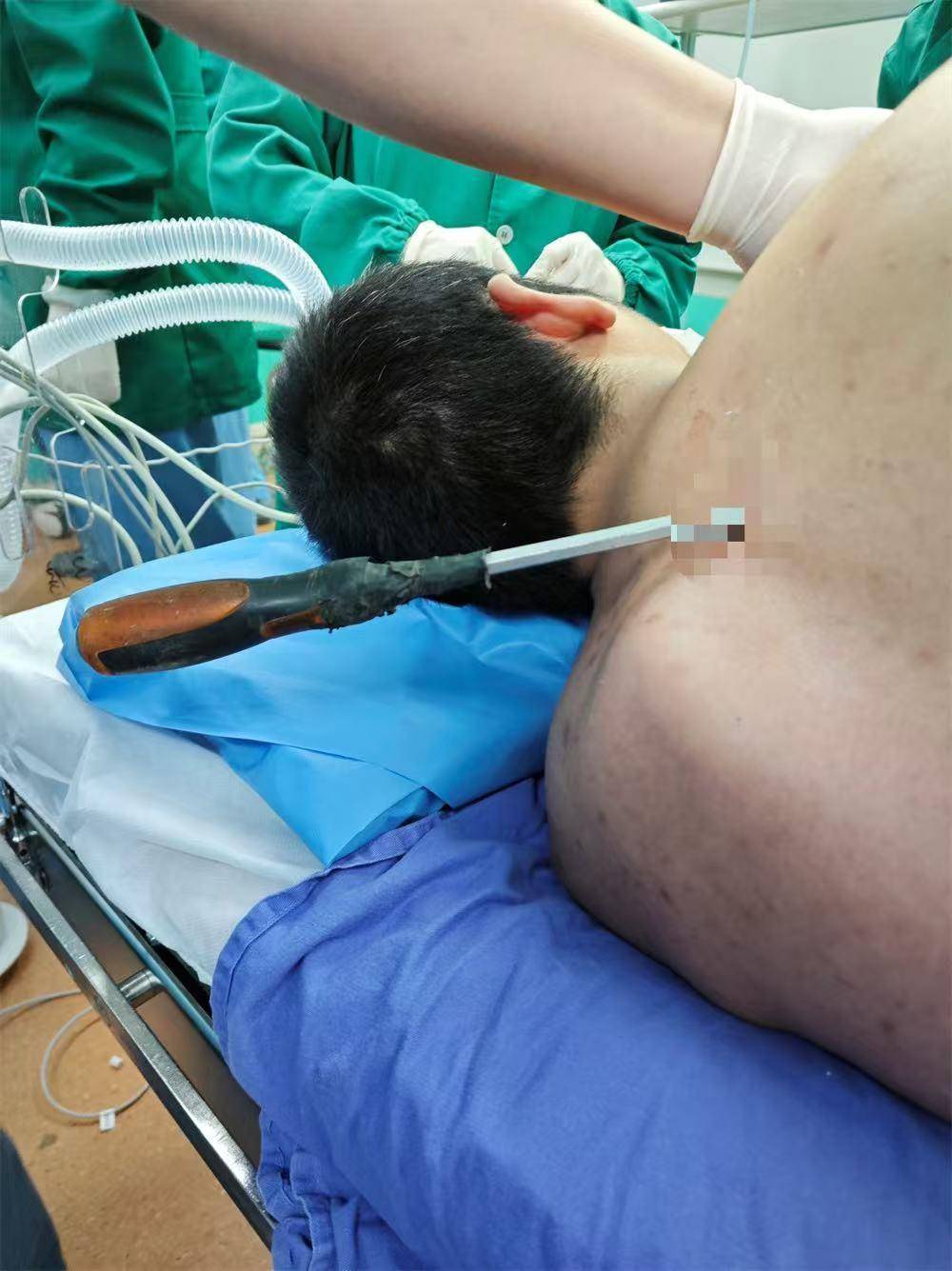 20米高空掉落螺丝刀直插男子胸腔<strong></p>
<p>如何利用行业消息去炒币</strong>！医生：不要自行拔除