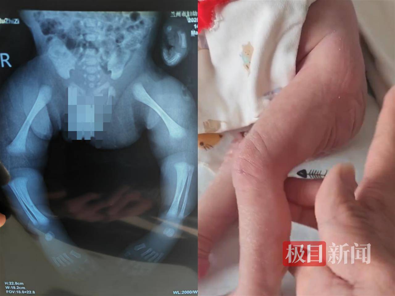 二胎出生查出先天性病症或落下残疾<strong></p>
<p>大饼</strong>，残疾父母称医院产检漏检、未尽告知义务，医院及医调委回应