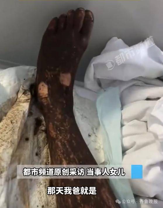 安徽宣城一男子走路玩手机<strong></p>
<p>shib币最新消息</strong>，一脚踩中打架的竹叶青和五步蛇，被俩毒蛇咬3口！医院：暂无生命危险，正在治疗