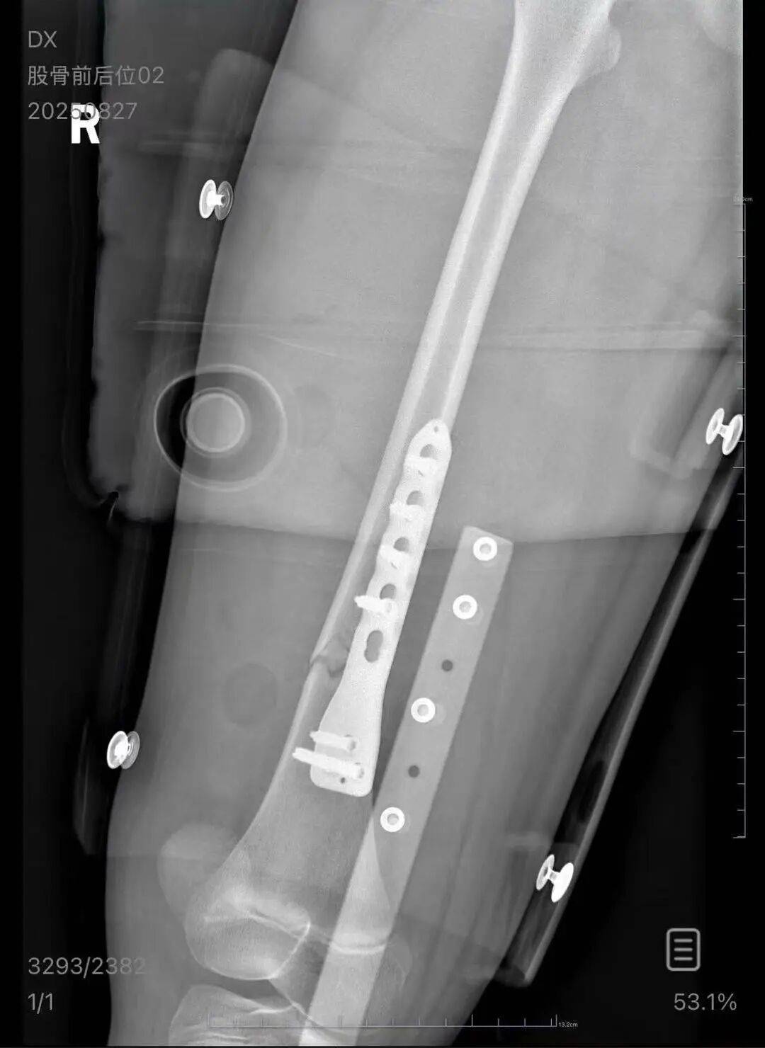 男子火车上铺跌落砸断10岁女孩腿骨<strong></p>
<p>usdt钱包</strong>,回应“失联”称失业讨薪中