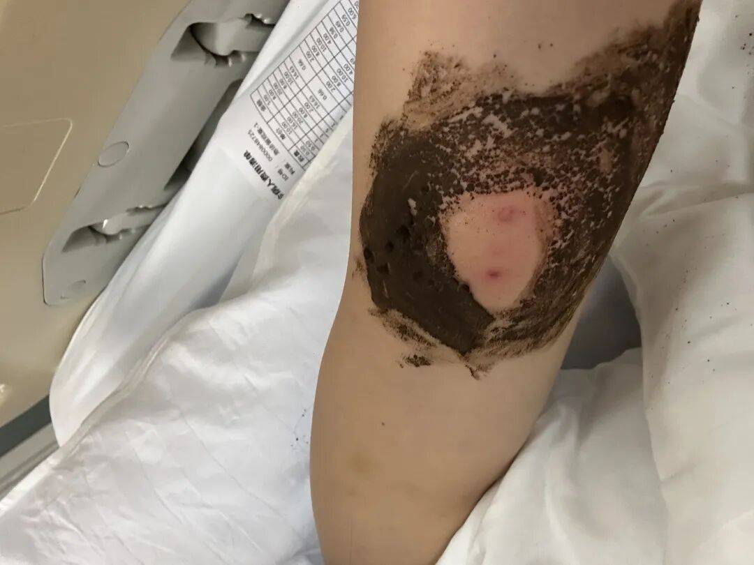 4名游客景区内遭马蜂袭击<strong></p>
<p>usdt币</strong>，旅游度假区：是森林公园不卖门票，蜇伤先就医后提供证据投诉