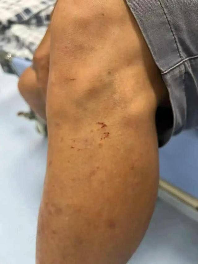 广东62岁阿叔网鱼网到2条眼镜蛇<strong></p>
<p>usdt价格</strong>，被咬伤后当场打死，并打包提进医院