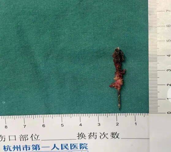 17岁小伙参军体检发现胸腔内有根5cm缝衣针<strong></p>
<p>巨力索具股票</strong>，父母回忆或是1岁时扎入，取出时已锈迹斑斑